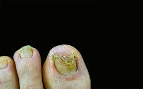 Factors Affecting Fungal Nail Infection Survival in Shoes