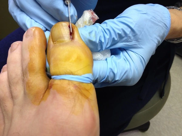How Long After Ingrown Toenail Surgery Can I Wear Shoes?