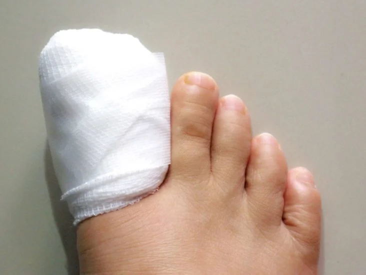 Tips for wearing shoes after ingrown toenail surgery