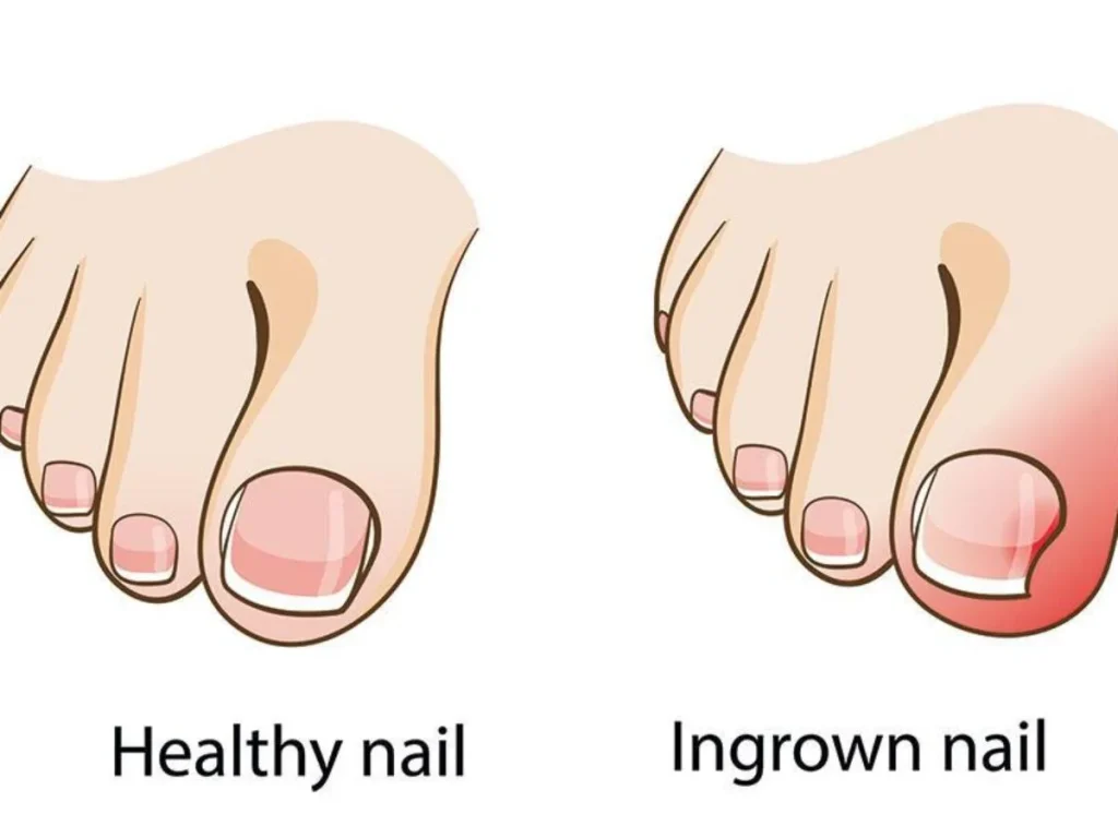 What are Ingrown Toenail