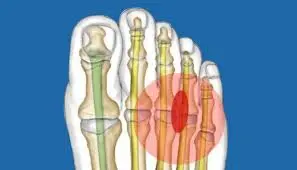 What is Morton's Neuroma Reality?
