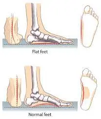 What are flat feet?