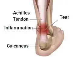 What is Achilles Tendonitis 