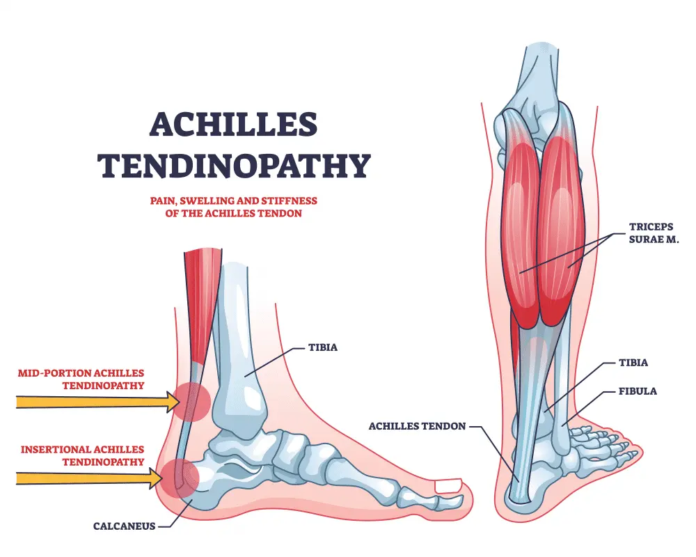 What is Achilles tendonitis?